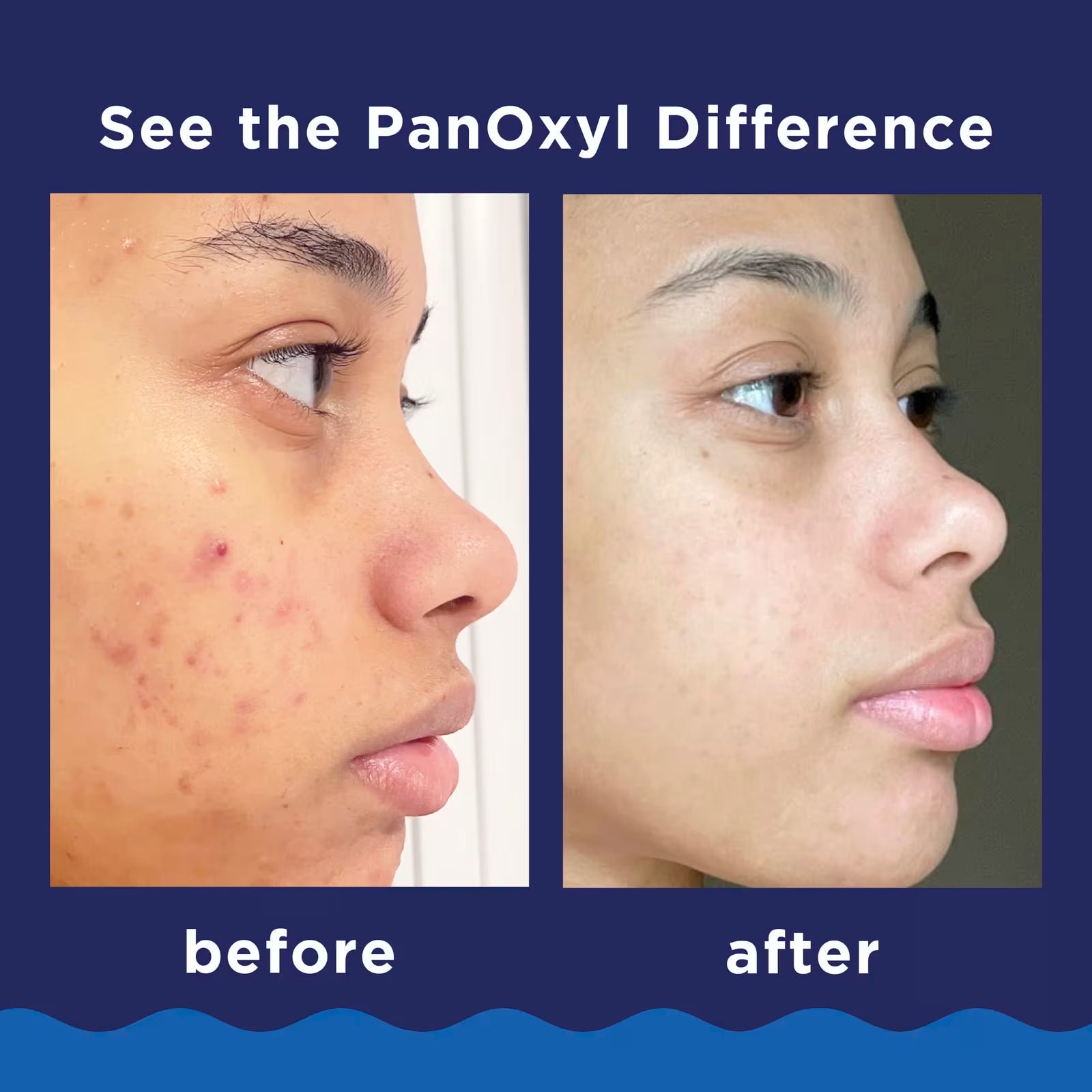 PanOxyl Acne Foaming Wash Peroxyde de Benzoyle 10 % 5,5 Oz 85g